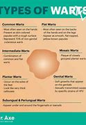 Image result for Types of Warts On Fingers