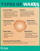 Image result for All Kinds of Warts