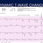 Image result for Anteroseptal MI ECG