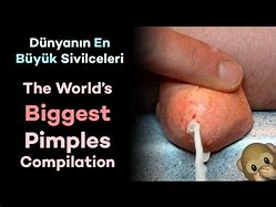 Image result for World's Most Biggest Pimple