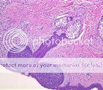 Image result for Basal Cell Papilloma