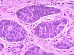 Image result for Carcinoid Tumor Histology
