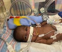 Image result for Most Premature Baby Born