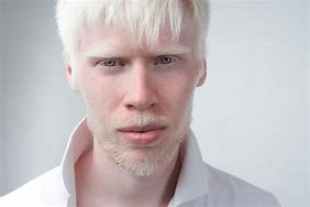 Image result for Albino White Person