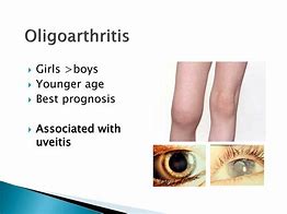 Image result for Oligoarthritis in Children