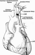 Image result for Woman Heart Bypass