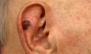 Image result for Basal Cell Carcinoma On-Ear