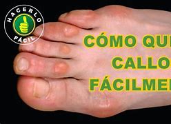 Image result for Pies Calloso