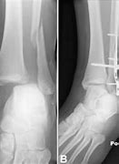 Image result for Broken Ankle Signs
