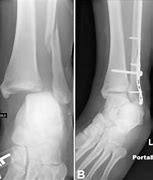 Image result for Broken and Dislocated Ankle