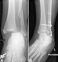 Image result for Broken Ankle Fracture