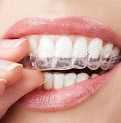 Image result for Straighten Teeth without Braces