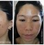 Image result for Vi Peel Process