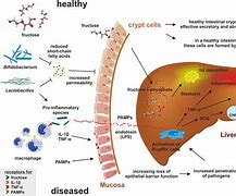 Image result for Fructose Malabsorption