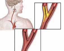 Image result for Stenosis of Carotid Artery