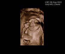 Image result for Anencephaly