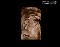 Image result for Anencephaly Radiology