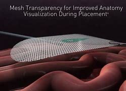 Image result for Abdominal Hernia Mesh