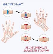 Image result for co_to_znaczy_zapalenie_stawów