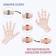 Image result for co_oznacza_zapalenie_stawów