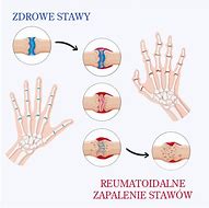 Image result for co_to_znaczy_zarostowe_zapalenie_tętnic