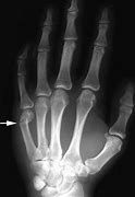 Image result for Broken Finger Knuckle