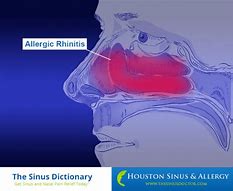 Image result for Sinus Allergies