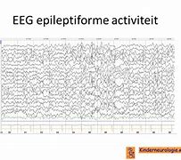 Image result for epileptiforme
