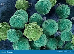 Image result for Hairy Cell Leukemia