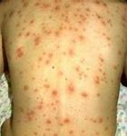 Image result for Chickenpox Dermnet