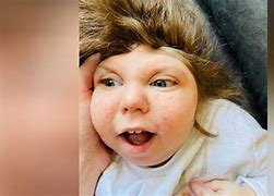 Image result for Kid Born without Brain