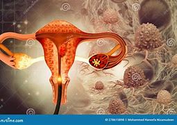 Image result for Comics Cervical Cancer