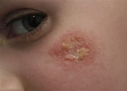 Image result for White Scab