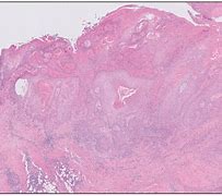 Image result for Verrucous Squamous Cell Carcinoma