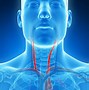 Image result for Carotid Artery Stroke Symptoms