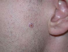 Image result for Basal Cell Carcinoma