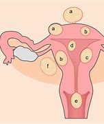 Image result for Pedunculated Uterine Fibroid
