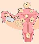 Image result for 6 Cm Fibroids in Uterus