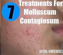 Image result for Molluscum Contagiosum Infection Treatment