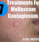 Image result for Best Treatment for Molluscum