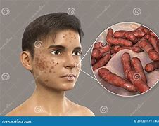 Image result for Acne Infection