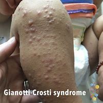 Image result for Gianotti-Crosti Syndrome Treatment