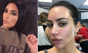 Image result for Kim Kardashian Eczema Cream
