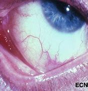 Image result for Kaposi Sarcoma Eye