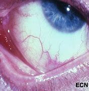 Image result for Kaposi Sarcoma Eye