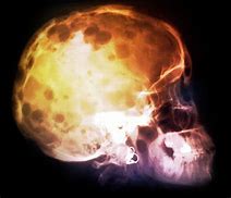 Image result for Skull with Bone Cancer