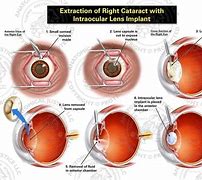 Image result for Lens Implants After Cataract Surgery