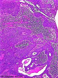 Image result for 2 Cm Tumor
