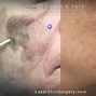 Image result for Actinic Keratosis On Forehead