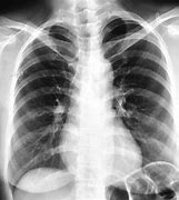 Image result for 2 Cm Nodule On Lung